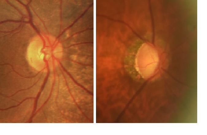 眼壓高=青光眼嗎？青光眼專科醫師幫你解惑！
